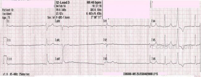 AV Block | ECG Guru - Instructor Resources